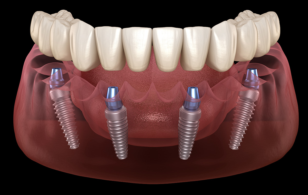 All-on-4 Dental Implants vs. Traditional Bridges: Which Is Best for Multiple Missing Teeth?