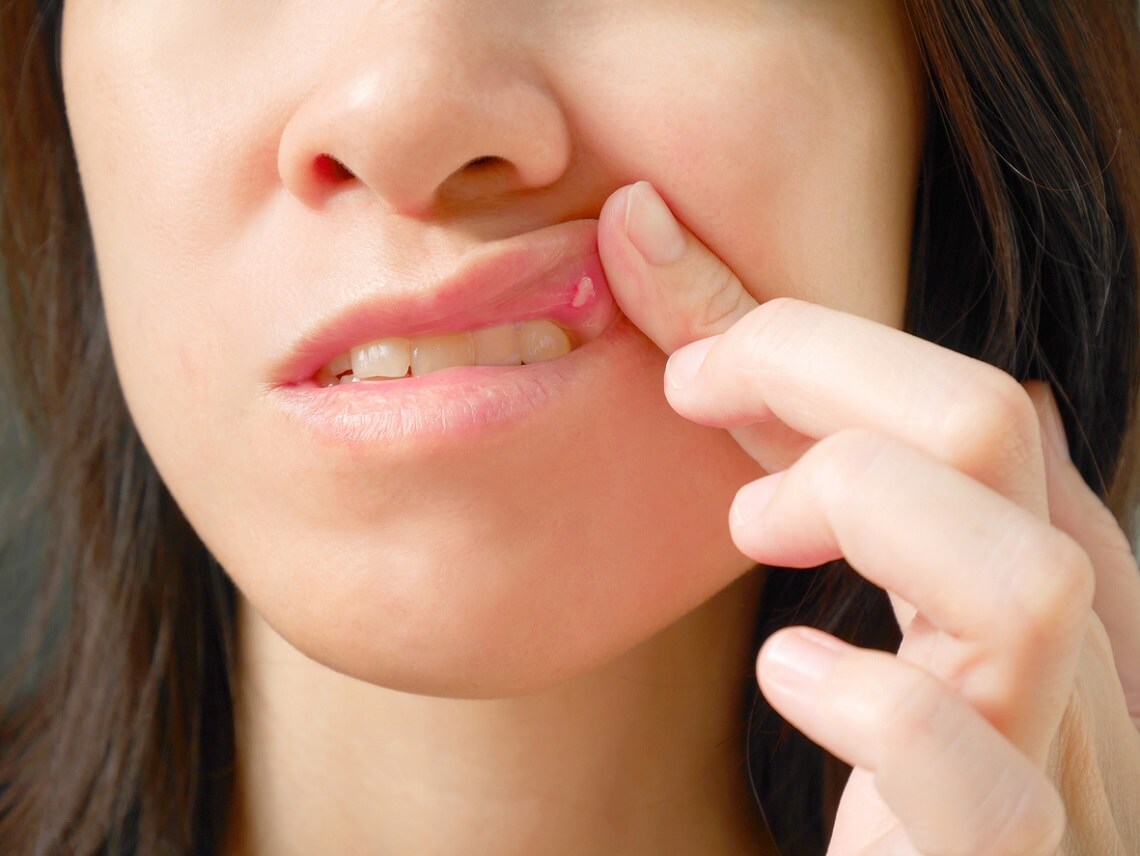 Are Canker Sores Related to Dental Health?