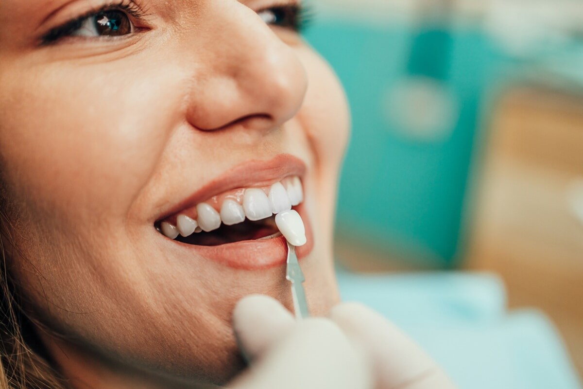dental veneer match