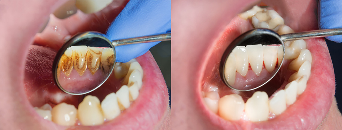 The Impact of Smoking on Your Oral Health