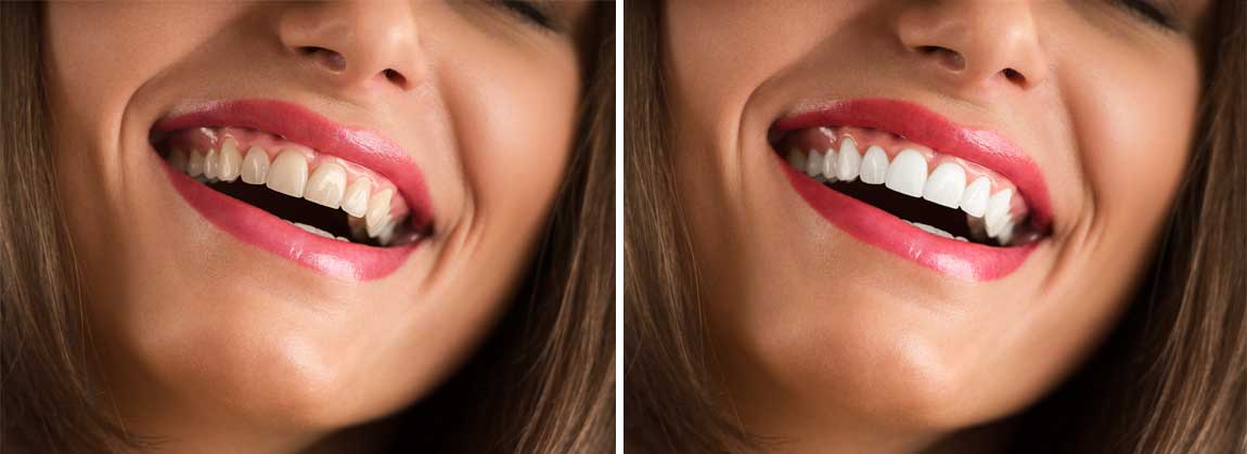 The 4 Most Popular Ways to Whiten Your Teeth